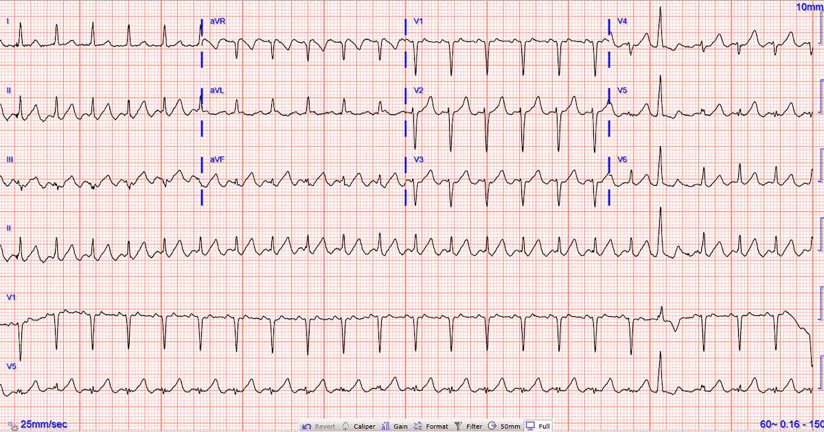 What Is the Relias Dysrhythmia Basic Test?