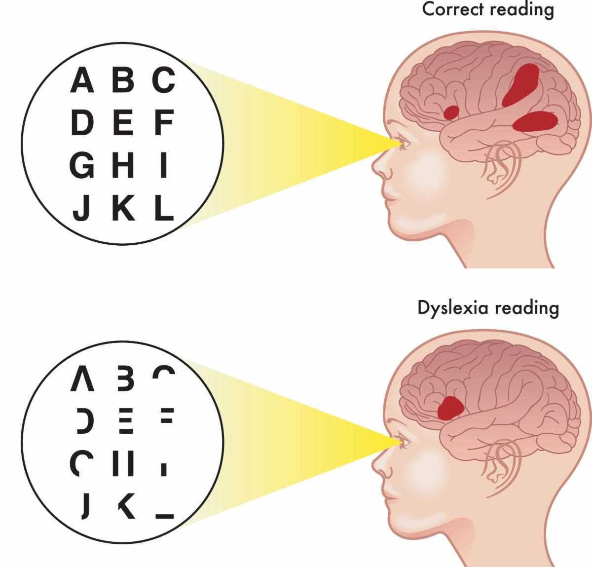 The Benefits of Early Dyslexia Detection