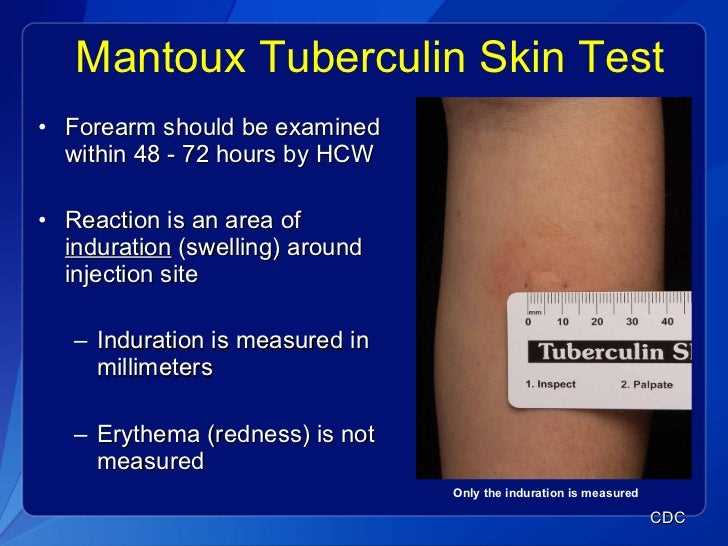 TB Testing: What You Need to Know