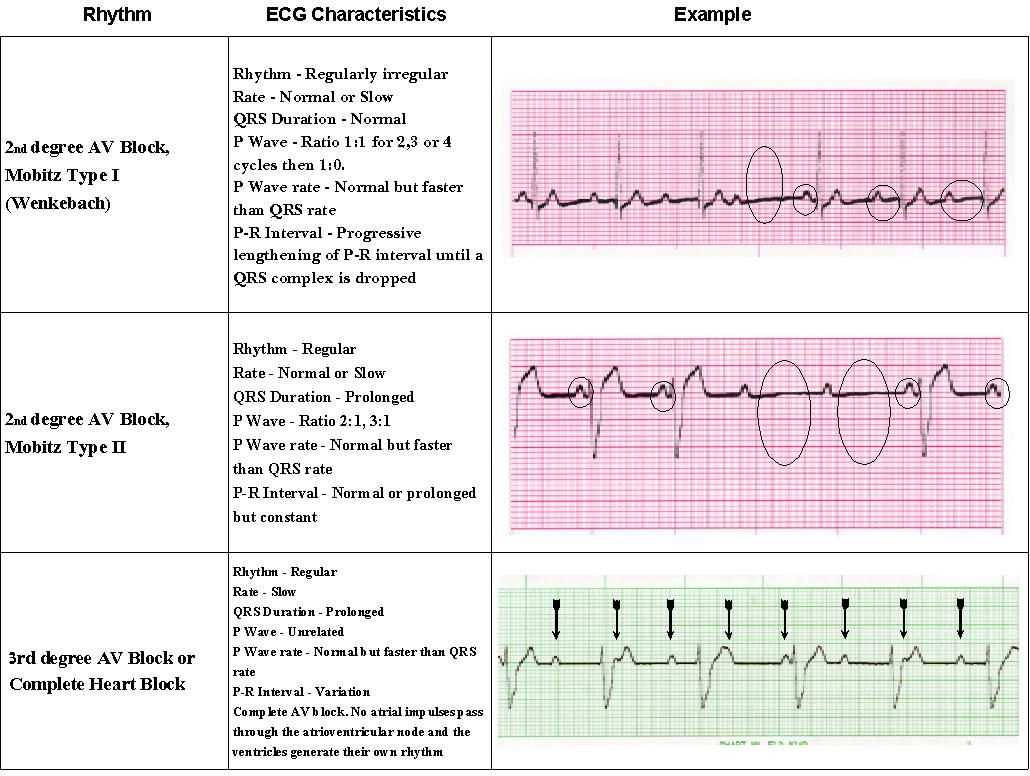 The Importance of Dysrhythmia Recognition